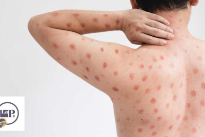 De-17-casos-de-viruela-simica-en Antioquia-solo-1-esta-activo